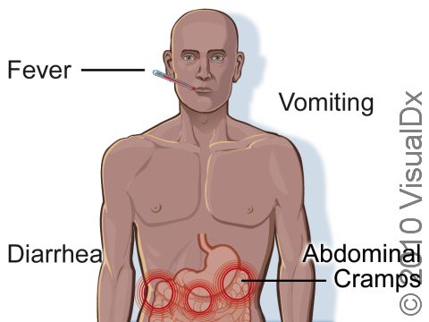 Salmonellosis (gastrointestinal infection with salmonella bacteria) leads to severe diarrhea and abdominal cramps.