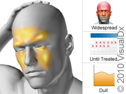 Sinus headaches involve pressure or pain in the forehead, brow, below or behind the eye, behind the ear, and, occasionally, sensitivity in the upper gums. The pain is typically focused in one area and lasts until treated.