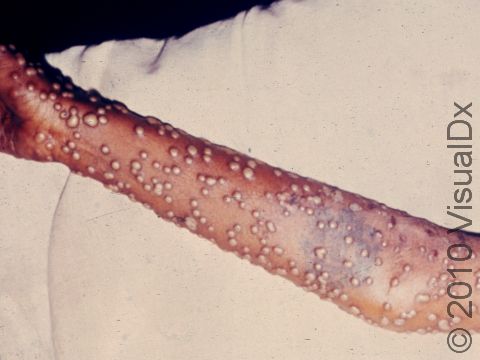 The blisters of smallpox are always at the same stage at the same time.