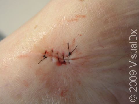 During suturing, the wound is cleaned and then pulled together with sutures, also known as stitches, to decrease healing time and allow the skin to heal with less scarring.