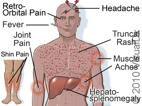 Trench fever is a bacterial disease transmitted by body lice. The symptoms include relapsing fevers, muscle aches, pain behind the eyes, severe headache, joint pain, rash, liver and spleen enlargement, and pain in the shins.