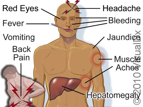 Yellow fever, a viral disease transmitted by mosquitos, can cause yellow skin (jaundice), bleeding, high fever, muscle aches, and severe illness sometimes leading to death.