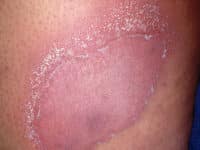 Generalized Pustular Psoriasis