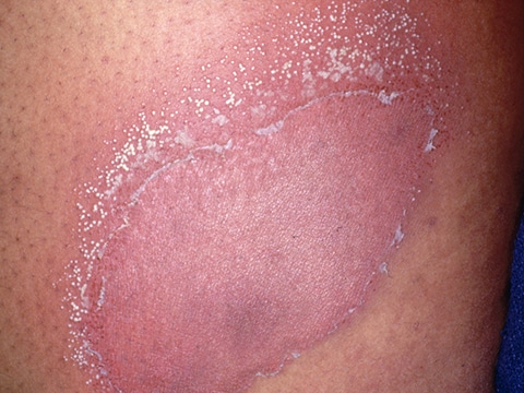 Red, scaly patches of skin with tiny pustules located along the edge of the redness in a patient with GPP.