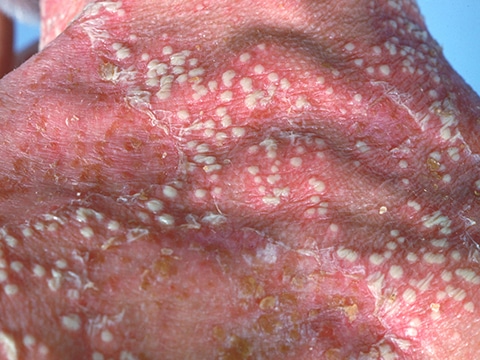 Patients with GPP commonly have large areas of redness with white pustules that become a yellow crust after rupture.