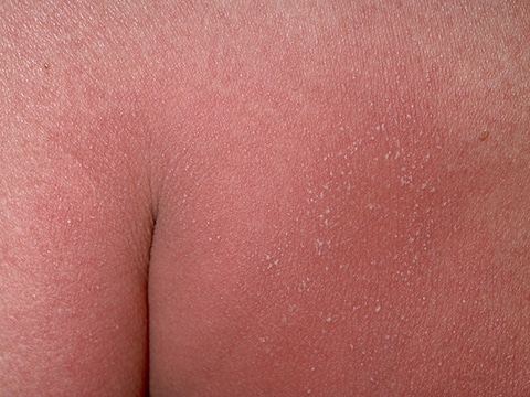 Large areas of redness and tiny pustules on the buttocks in a person with GPP.