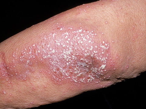 An image of GPP showing a collection of pustules within red, irritated skin on the elbow.