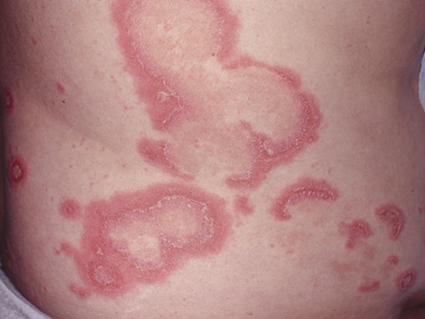 A common presentation of GPP on the trunk, where lesions have a curved or circular pattern with pustules at the edges.