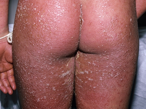 Severe GPP, with peeling of the skin and widespread pustules that aggregate and form larger areas known as 