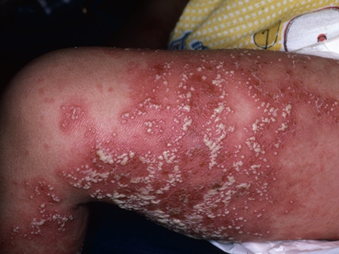 The leg of a patient with classical GPP characterized by prominent pustules within red, irritated skin.